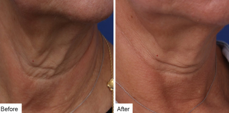 Neck Rejuvenation