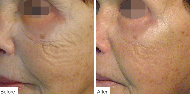 Wrinkle Reduction